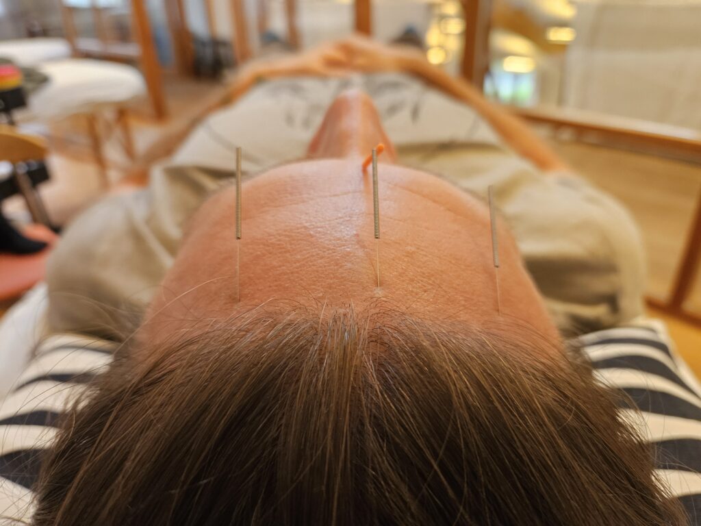 SIND Akupunktur panden